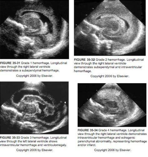 Intraventricular Hemorrhage Ultrasound Grades Images And Photos Finder