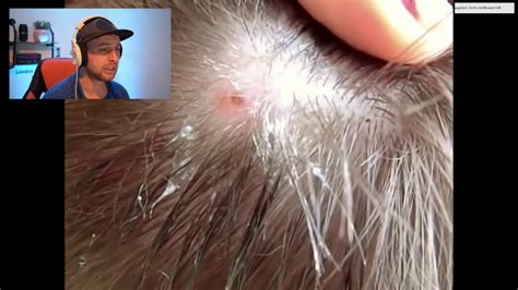 Huge Botfly Maggot Removed From Head Of This Man Youtube