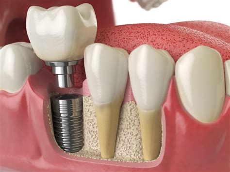 Dental Implants Everything You Need To Know