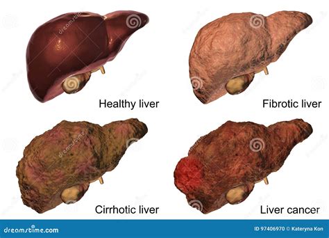 Fibrotic Liver In Obese Man D Illustration Cartoondealer