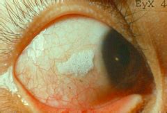 It is a form of skin when a person has these white spots, they can vary in size from small to large white spots. Clinical Signs of Iron Deficiency Anaemia, Vitamin A ...