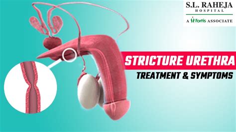 Urethral Stricture Symptoms Diagnosis Urethra Anatomy How Do You
