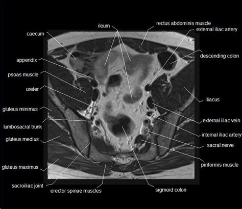 The pelvis and the pelvic floor muscles seal the abdominal and pelvic cavity in a caudal direction; MRI pelvis anatomy | free male pelvis axial anatomy