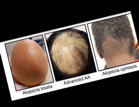 Alopecia Areata Many Different Forms — Donovan Hair Clinic