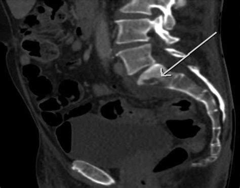 Portal Venous Phase Ct Showing Segmental Sigmoid Colon Thickening
