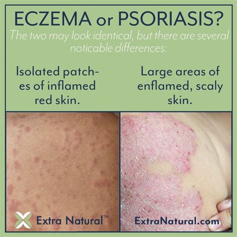 Eczema Vs Psoriasis Are They One And The Same Artofit