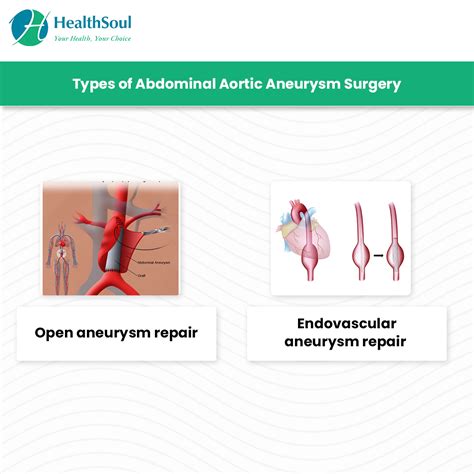 Abdominal Aortic Aneurysm Surgery Indications And Risks Healthsoul