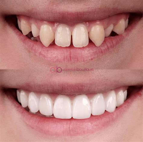 See full list on ladentalclinic.com Porcelain Veneers in Melbourne | Dental Boutique