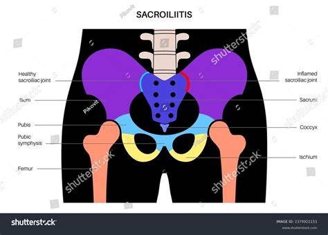 Sacroiliitis Disease Concept Inflamed Sacroiliac Joints Stock Vector