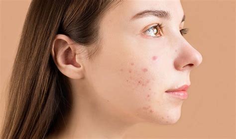 How To Treat Cystic Acne Klarity Health Library