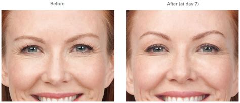 Botox Crows Feet Before And After Galleries Pictures Long Beach