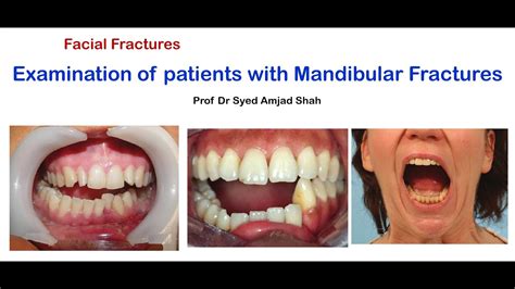Examination Of Patients With Mandibular Fracture Oral And Maxillofacial Surgery Syed Amjad