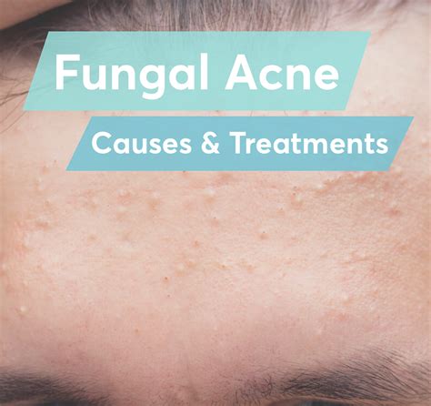 Fungal Acne On Body
