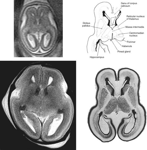 Sectional Anatomy Of The Fetal Brain Radiology Key