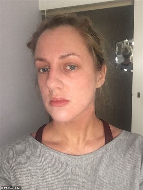 Woman 32 Releases Graphic Photo Diary Showing Red Raw Skin After
