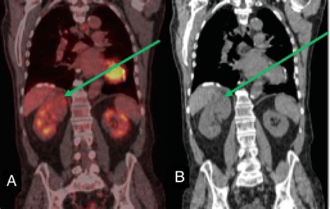 Renal Cell Carcinoma Coronal Fdg Pet Ct A And Concurrent Ct B