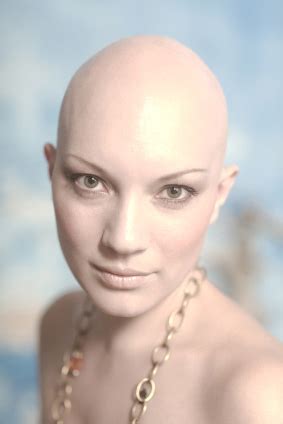 What Causes Baldness Female Baldness