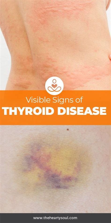 Skin Signs Of Thyroid Disease Thyroid Signs Thyroid Disease Thyroid