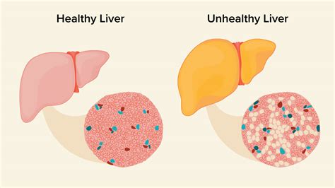 Early Symptoms Of Fatty Liver Disease Recognize Disease