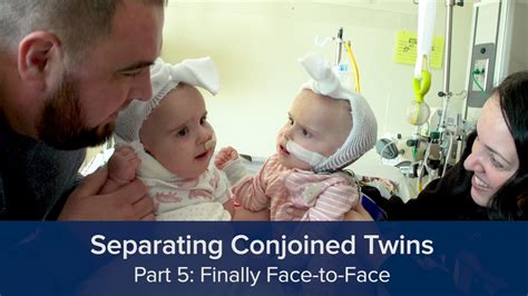 Separating Conjoined Twins Part 5 Finally Face To Face Youtube