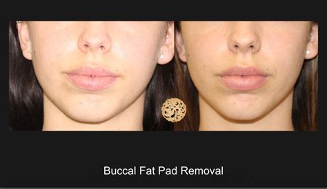 Buccal Fat Removal Before And After Gallery Dr Nazarian