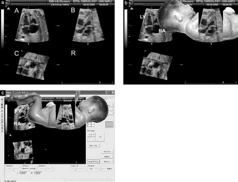 Standardization Of On‐screen Fetal Heart Orientation Prior To Storage