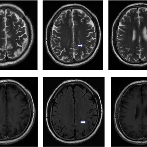 Brain Mri In April 2011 In Bilateral Frontal Parietal Temporal And