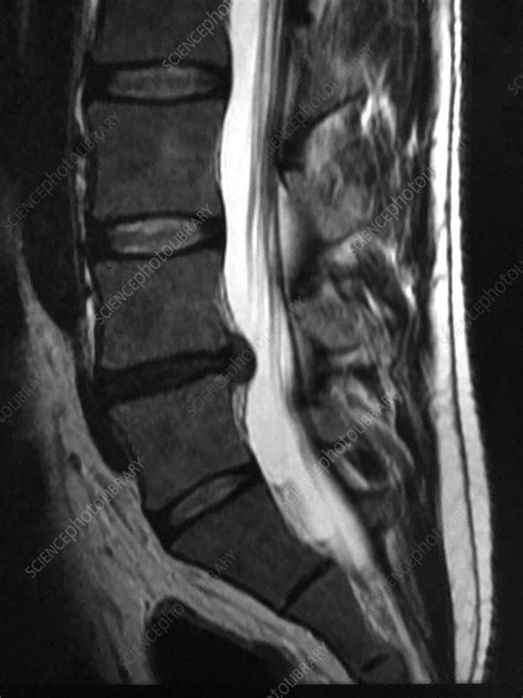 Lumbar Disc Herniation Mri Stock Image C0394164 Science Photo