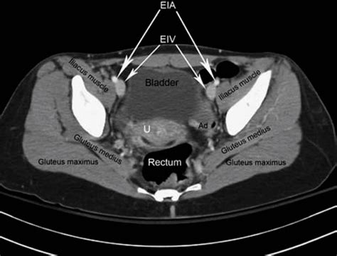 Ct Scan Anatomy Pelvis Images And Photos Finder