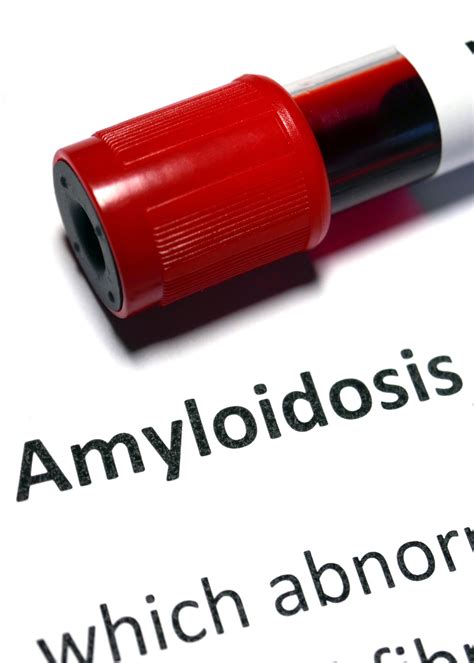 What Is Amyloidosis And How Is It Treated University Of Utah Health