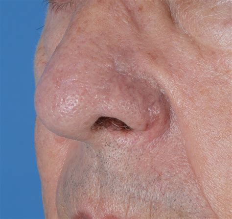 Lower Third Nasal Skin Grafting Intechopen