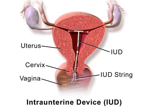 Sex With Iud Can You Feel The Iud While Having Sex