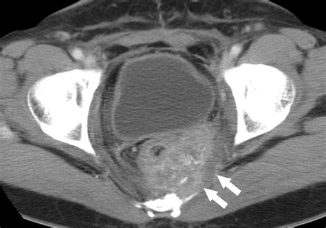 Uterine Cervical Carcinoma After Therapy Ct And Mr Imaging Findings