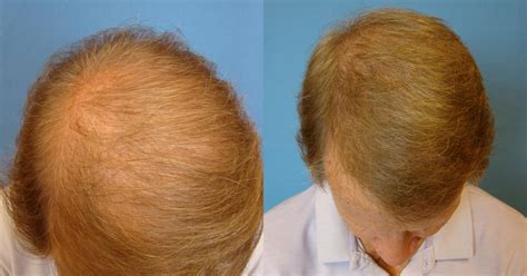 Neograft Hair Replacement Before And After Pictures Case