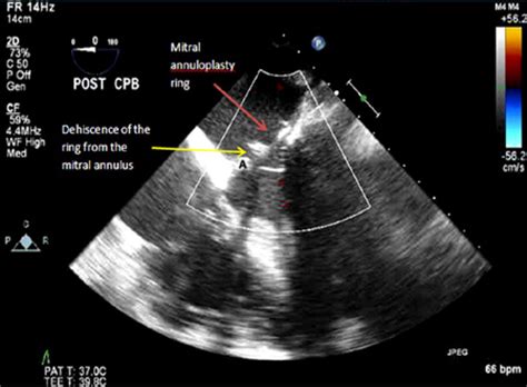 Mitral Valve Annuloplasty Ring Dehiscence Diagnosed Intraoperative With