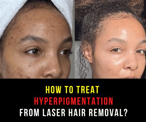 How Does Laser Remove Hyperpigmentation Justinboey