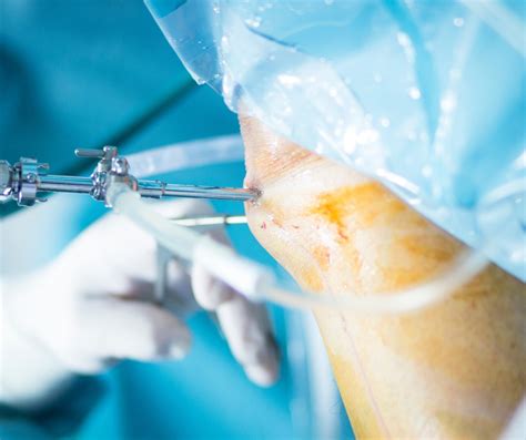 Arthroscopic Procedures How They Work And Help Dr Mahesh Bagwe