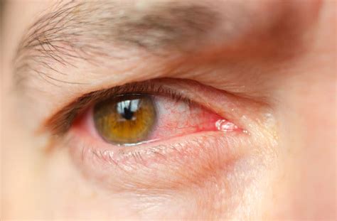 Eye Infection Types Symptoms And How To Treat Them All About Vision