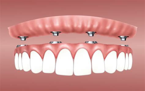 Dentadura Fija Sobre Implantes Clinica Dental Palomero