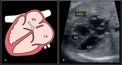 Atrial Ventricular And Atrioventricular Septal Defects Obgyn Key