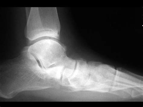 Posterior Tibial Tendon Insufficiency Ptti Foot And Ankle Orthobullets