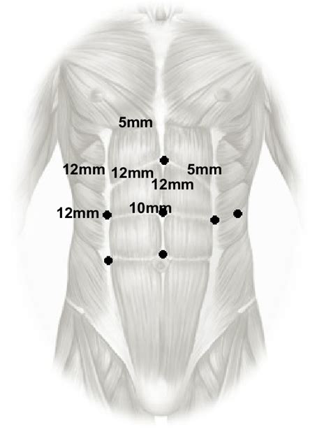 Trocar Placement For Laparoscopic Sleeve Gastrectomy Download Scientific Diagram