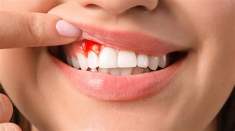 Why Are Your Gums Bleeding Manchester Dentist