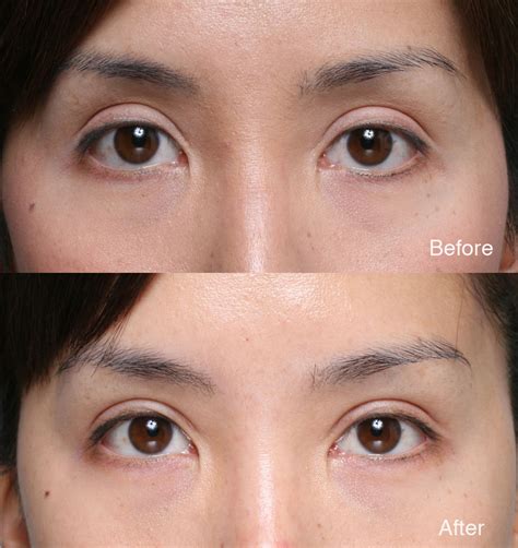 Asian Eyelid Surgery Example 2 L Steinsapir Kenneth