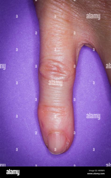 Dedo deformado por el reumatismo Fotografía de stock Alamy