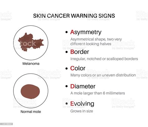 Melanoma Warning Signs Stock Illustration Download Image Now