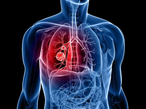 Enfisema Pulmonar Qu Es Causas Complicaciones Tratamiento Y M S