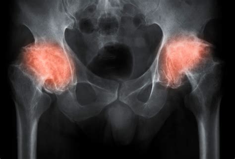 6 Signs You May Need A Hip Replacement Hip And Knee Orthopedics
