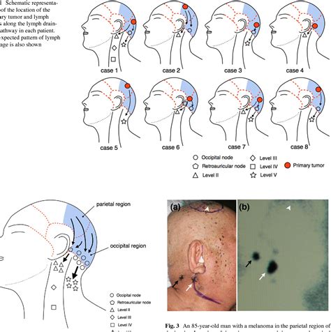 Dominant Lymph Drainage Patterns In The Occipital And Parietal Regions
