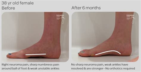 However, sometimes surgery is inevitable. Fix Flat Feet - Natural Non-Surgical Correction by ...